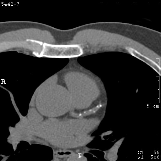 Calcium Scoring Test for Coronary Heart Disease now available